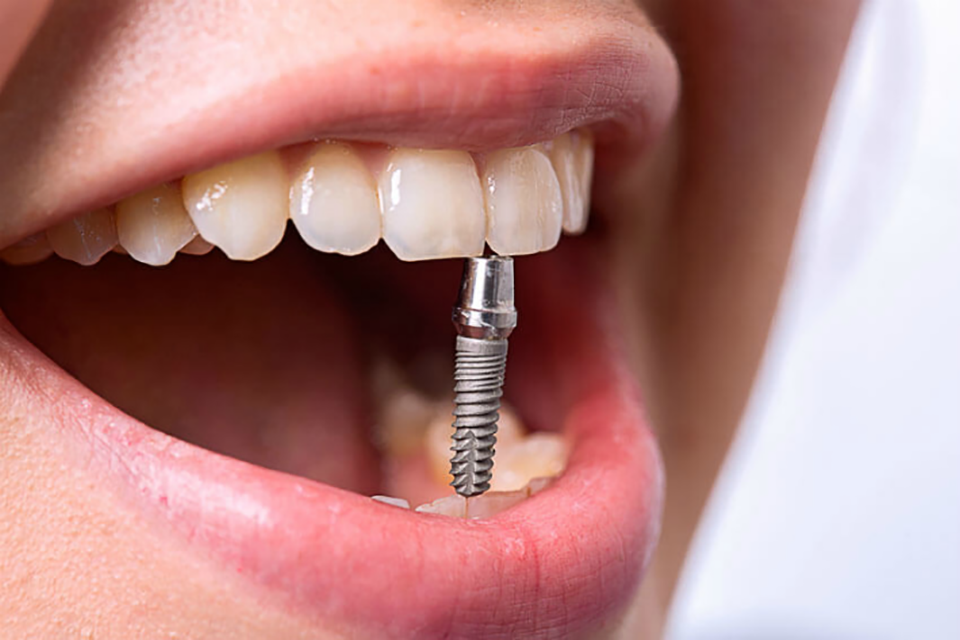 Имплантация зубов: преимущества, особенности процедуры — Мой Город ...