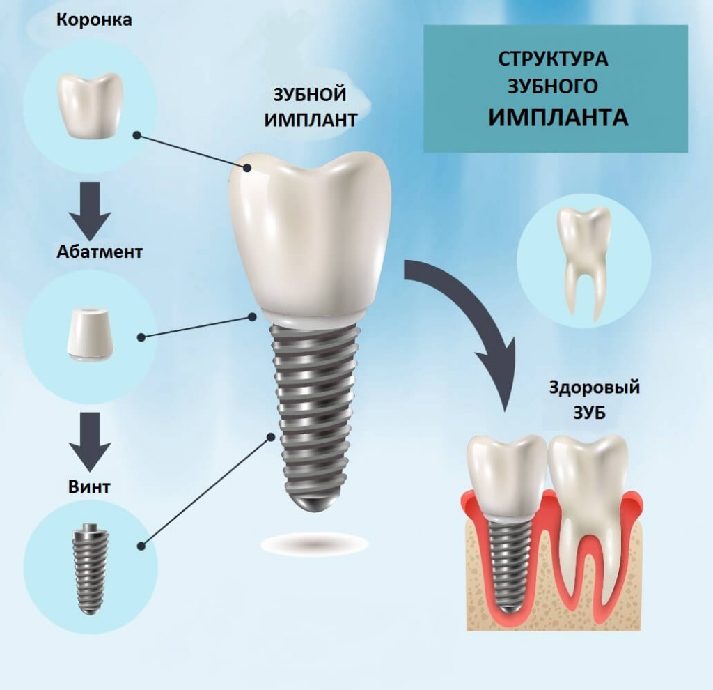 Этапы имплантации зубов: чего ожидать во время процедуры