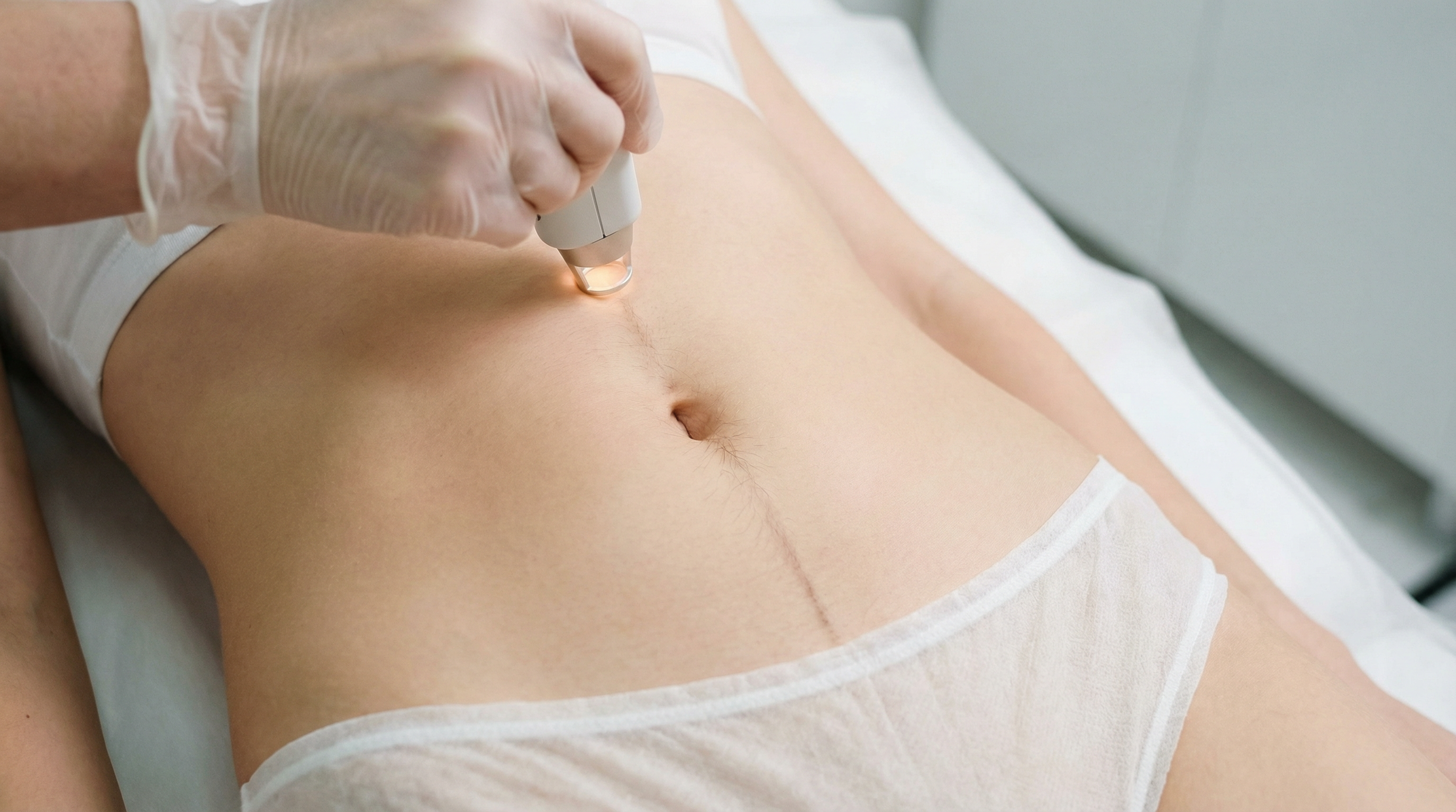 лазерная эпиляция белой линии живота — зона обработки